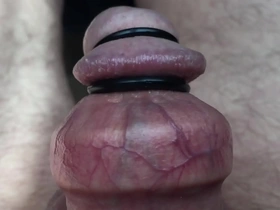 Stretched foreskin and rubber band on and under the glands.